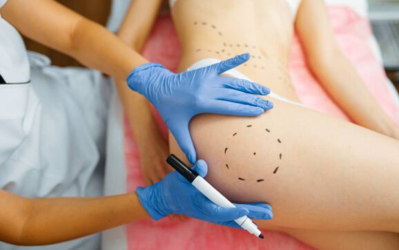 Cosmetician with marker puts dotted lines on female patient body, botox injections preparation. Rejuvenation procedure in beautician salon. Cosmetic surgery against wrinkles and aging